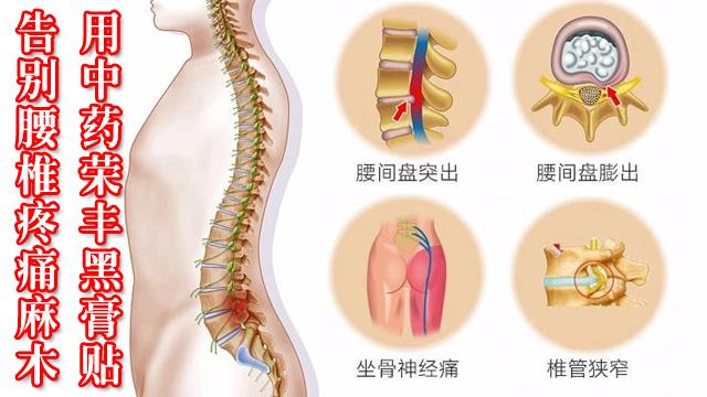 腰椎间盘突出最新疗法｜腰椎间盘突出治疗新进展